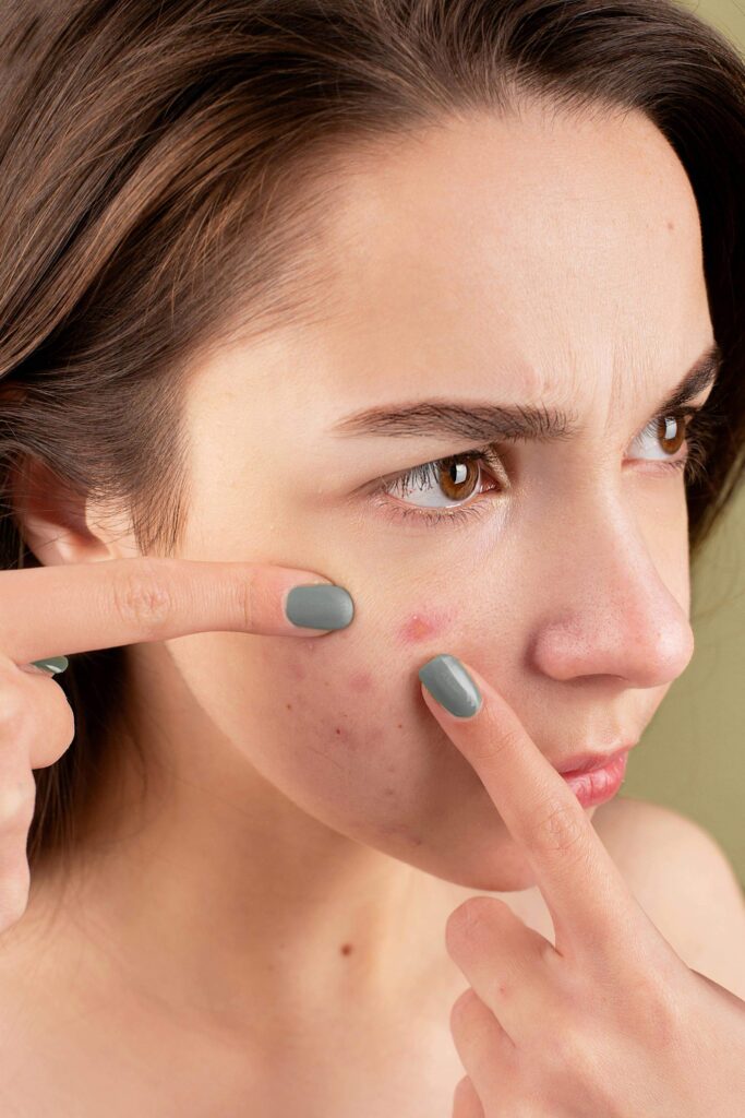 cleansing your face can help prevent acne